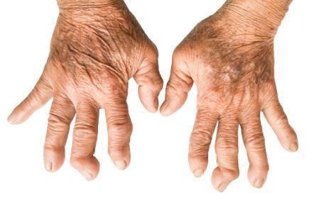 RA-rheumatoid arthritis