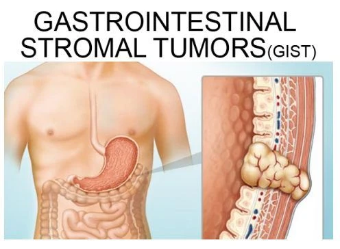 GIST
